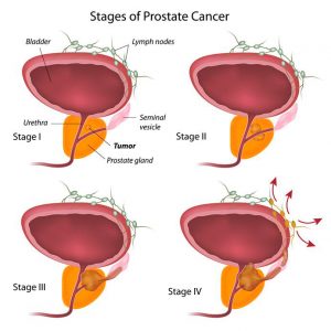 Etapas del Cáncer de Próstata
