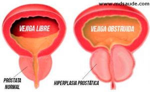 Detalle Hiperplasia benigna de próstata 